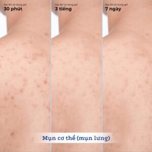 Gel bôi trị mụn Blissberry Pureskin Acne Fixer K21 - hinh 012