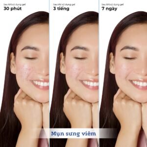 Gel bôi trị mụn Blissberry Pureskin Acne Fixer K21 - hinh 09